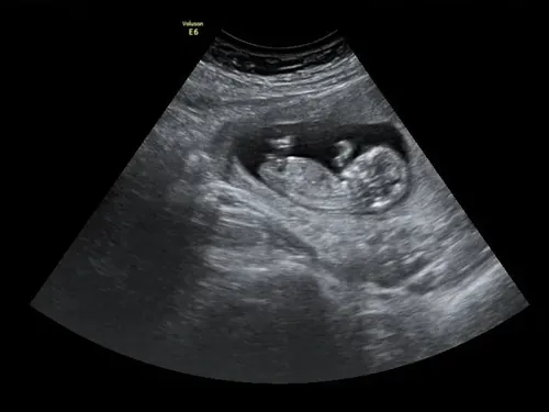 Real keepsake ultrasound image from Preggoland Mamas