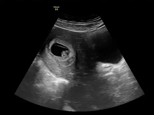 2D regular ultrasound (most popular for early pregnancies)