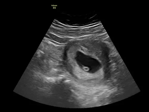 Real keepsake ultrasound image from Preggoland Mamas